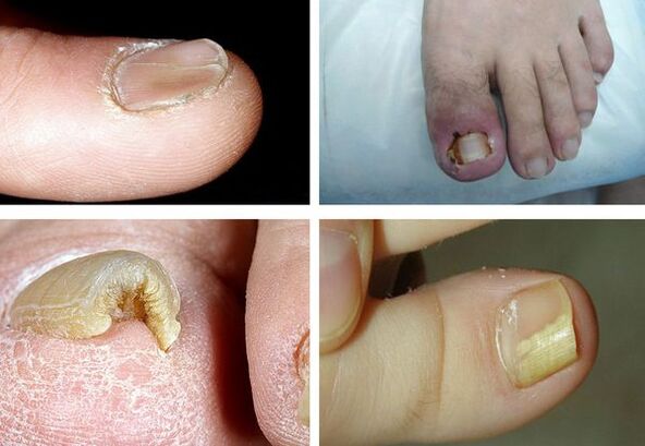 Symptome von Beinen in den Beinen